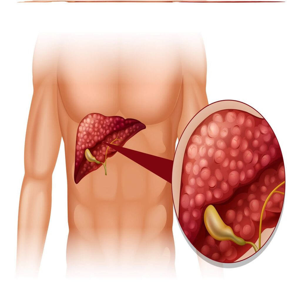 fatty-liver-image